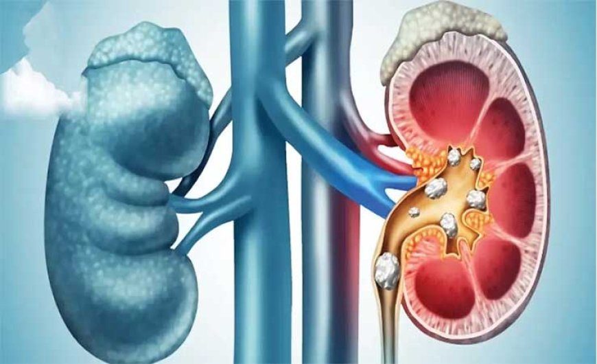 যেসব কারণে মূত্রনালিতে পাথর হতে পারে